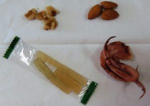 総義歯治療の一例